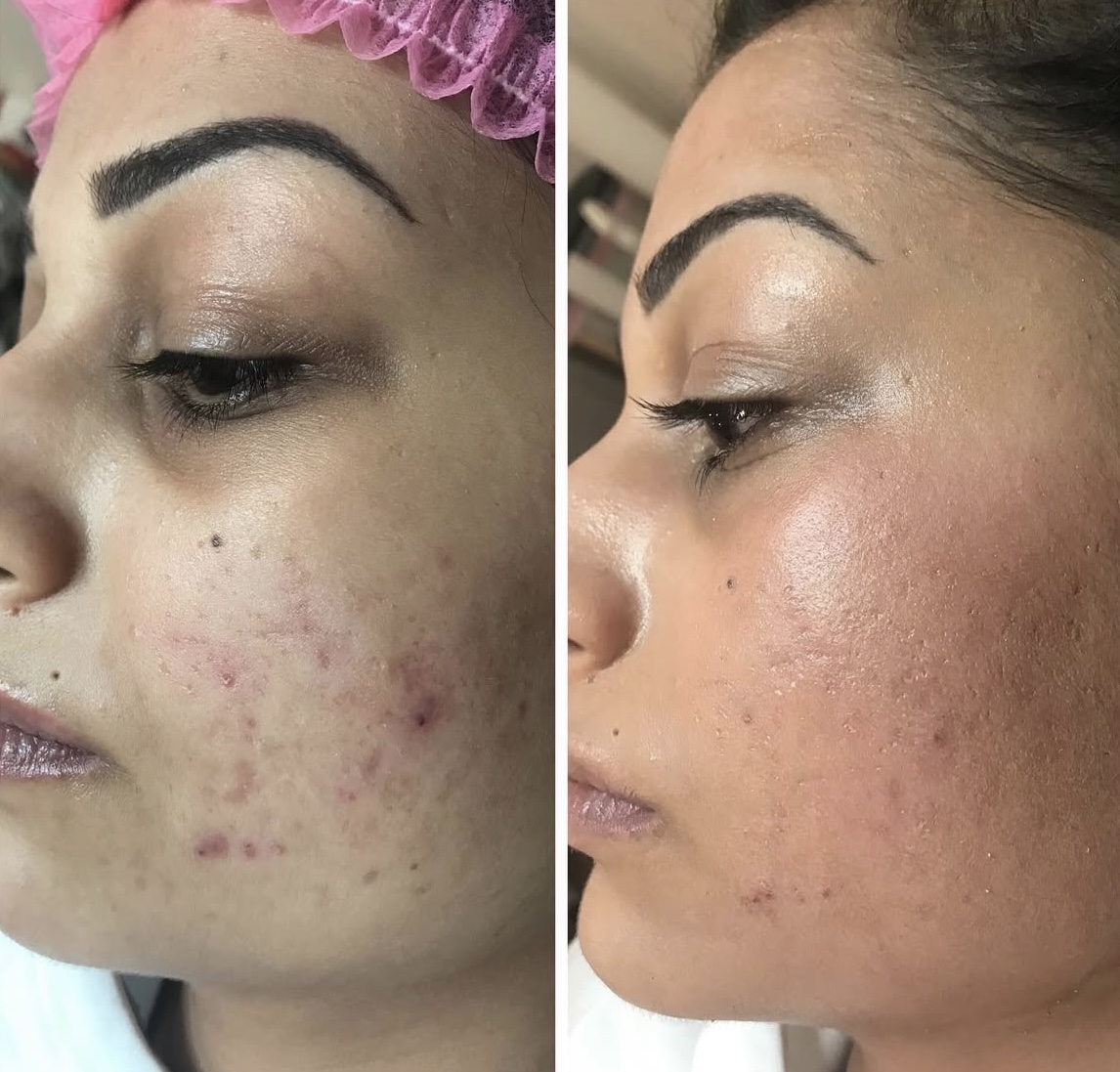 Unreine Haut vor und nach einer klärenden Gesichtsbehandlung